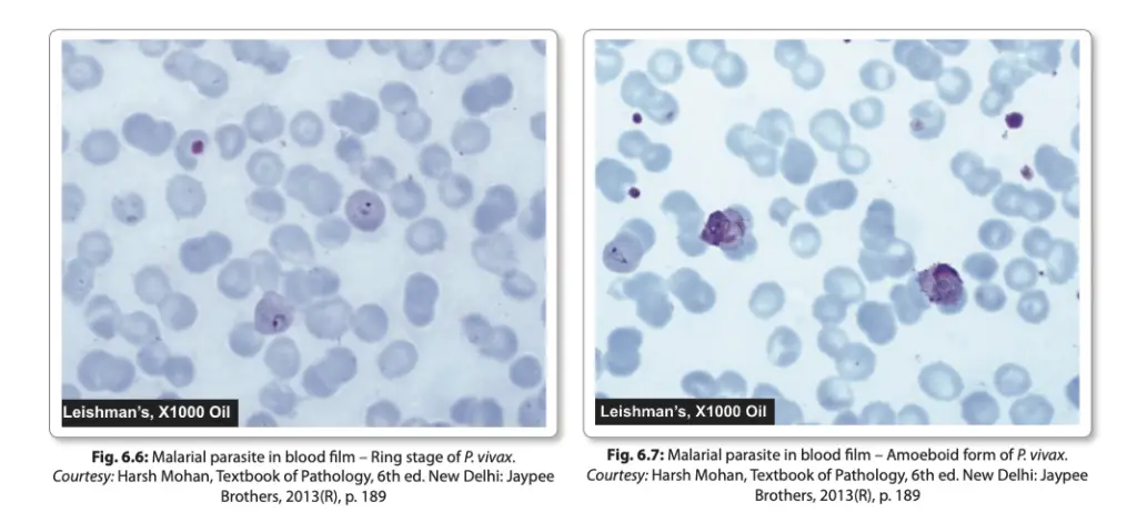 Laboratory Diagnosis of Malarial Parasites