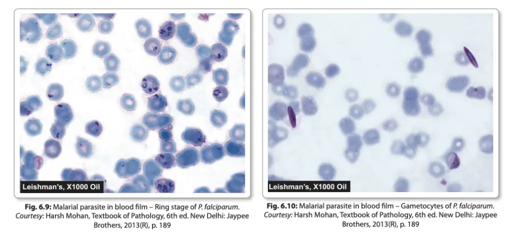 Laboratory Diagnosis of Malarial Parasites