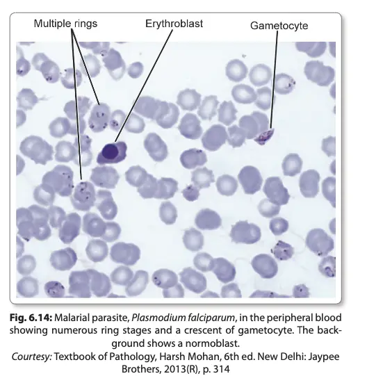 Laboratory Diagnosis of Malarial Parasites