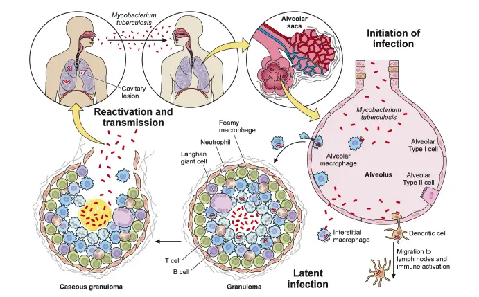 Overview of Mtb infection. Mtb enters the human body through the airway where it engages the innate immune system within the alveolar space. Macrophages and dendritic cells ingest the bacteria, recruiting new cells and activating adaptive immunity. Together, the innate and adaptive immune systems collaborate to eradicate the bacteria or restrict its active replication within a granuloma. Active tuberculosis occurs either after primary infection or after reactivation due to immunodeficiency, leading to symptomatic disease and transmission to a new host to start a new infection cycle.