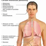 Symptoms of Carbon Monoxide Poisoning