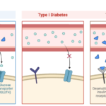 Type I vs. Type II Diabetes