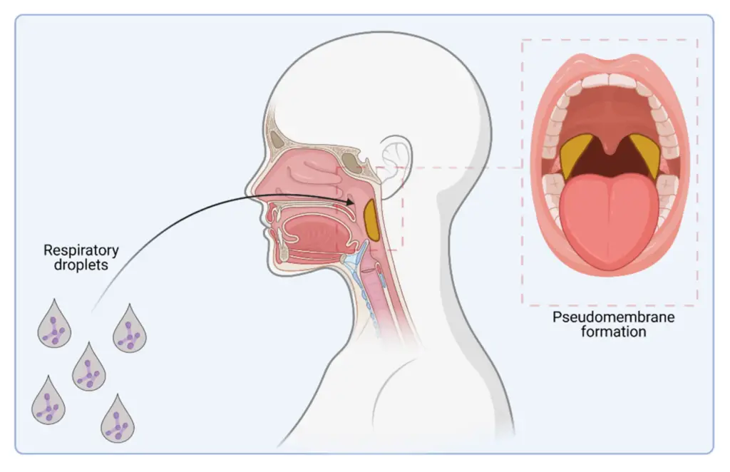 C. diphtheriae infection.