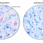 Comparison of Kinyoun-stained microscopic fields showing slender red acid-fast bacilli in a positive preparation and blue counterstained non-acid-fast bacteria in a negative preparation.