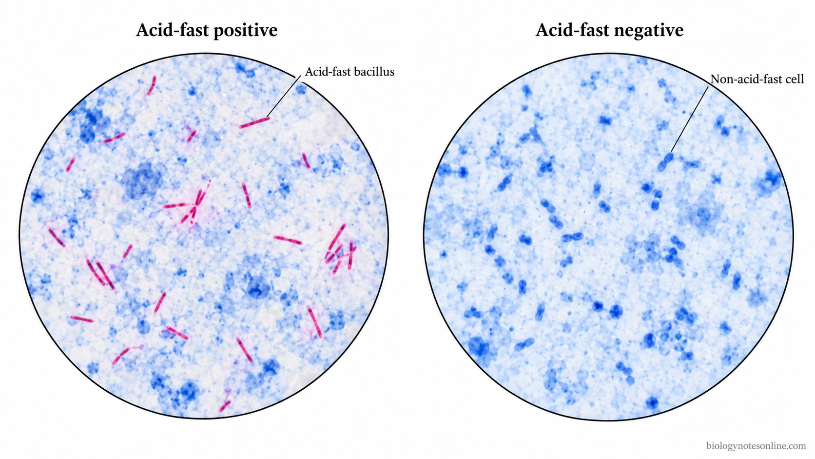 Comparison of Kinyoun-stained microscopic fields showing slender red acid-fast bacilli in a positive preparation and blue counterstained non-acid-fast bacteria in a negative preparation.