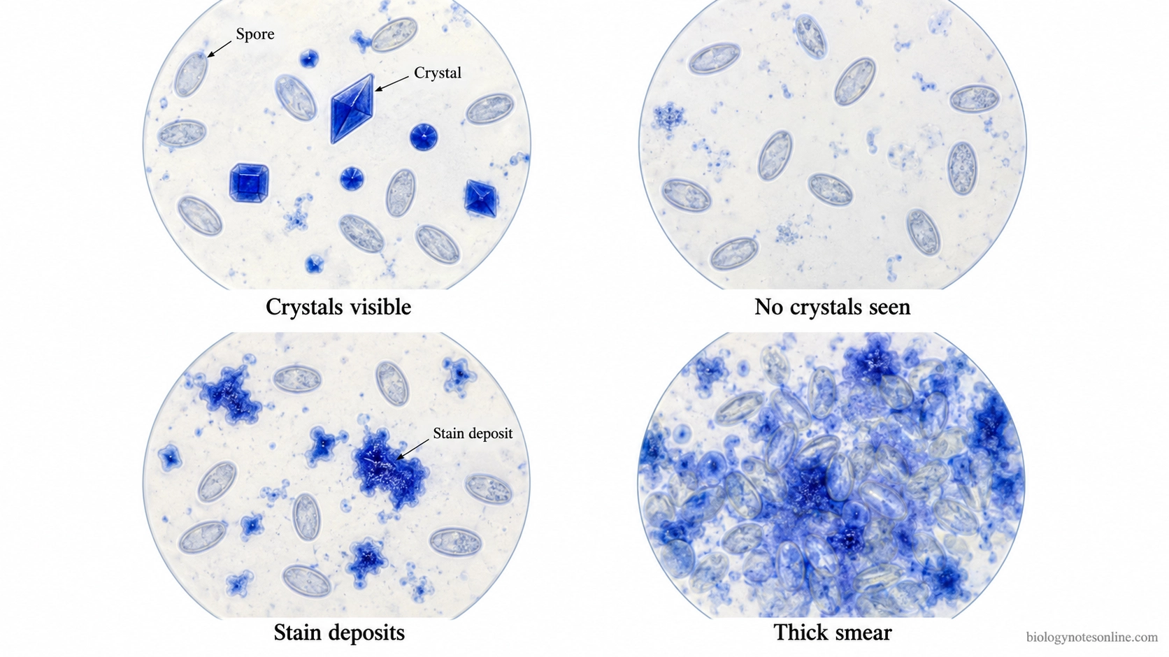 Four illustrated microscope fields comparing visible blue parasporal crystals, no detectable crystals, irregular stain deposits and a crowded smear.