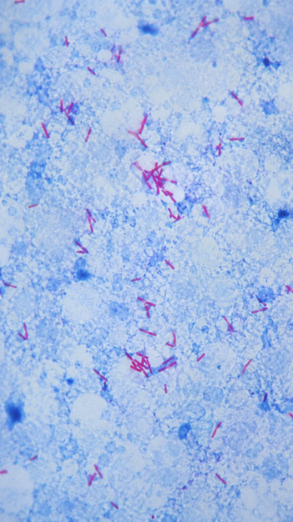 Acid Fast Bacteria – Mycobacterium