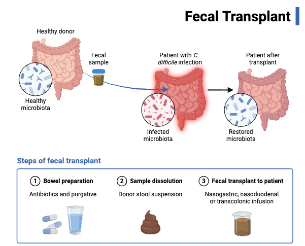 Fecal Transplant