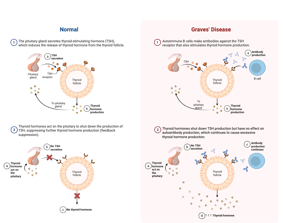 Autoimmune Disease - Definition, Types, Diagnosis, Treatment, Examples 7 Graves' Disease