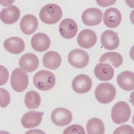 Plasmodium in Blood Smear - Microscopic Image