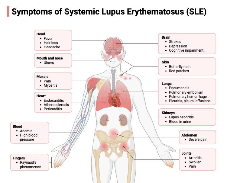 Autoimmune Disease - Definition, Types, Diagnosis, Treatment, Examples 9 Symptoms of Systemic Lupus Erythematosus (SLE)